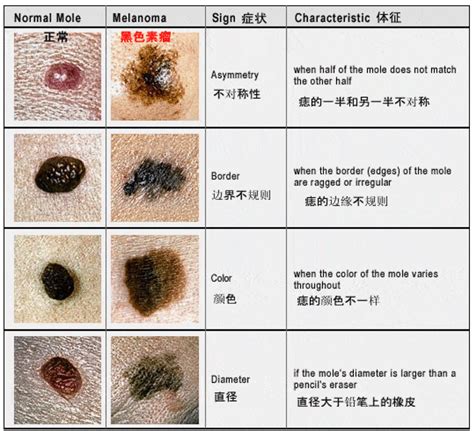 大痣|有这5种“痣”要小心，可能会恶变